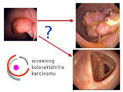 Screening kolorektálního karcinomu